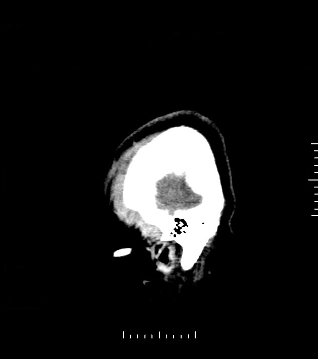 Cholangiocarcinoma with cerebral metastases (Radiopaedia 83519-98628 C 1).jpg