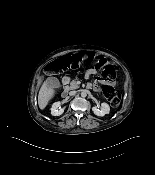 Cholangiocarcinoma with cerebral metastases (Radiopaedia 83519-98629 Axial C+ delayed 43).jpg