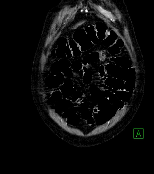 Cholangiocarcinoma with cerebral metastases (Radiopaedia 83519-98629 E 13).jpg