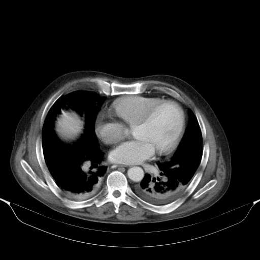 File:Cholangitis and abscess formation in a patient with cholangiocarcinoma (Radiopaedia 21194-21100 A 4).jpg