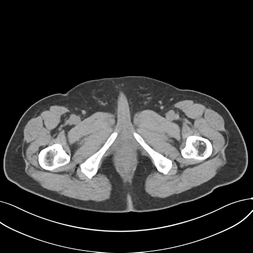 File:Cholecystitis with focal perforation and hepatic abscess (Radiopaedia 37189-38945 Axial non-contrast 91).png