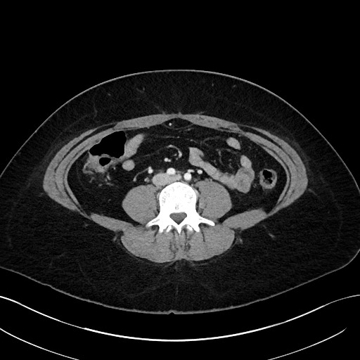 File:Choledocholithiasis after recent cholecystectomy (Radiopaedia 60929-68737 Axial 6).jpg
