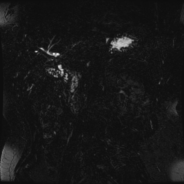 Choledocholithiasis on CT and MRI (Radiopaedia 24825-25088 Coronal T2 27).jpg