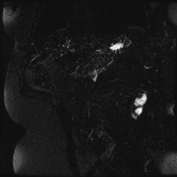 Choledocholithiasis on CT and MRI (Radiopaedia 24825-25088 Coronal T2 83).jpg
