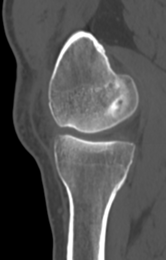 Chondrocalcinosis (Radiopaedia 82862-97173 Sagittal bone window 21).jpg