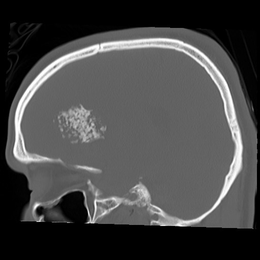 File:Chondrosarcoma - sphenoid wing (Radiopaedia 58259-67828 Sagittal bone window 19).jpg