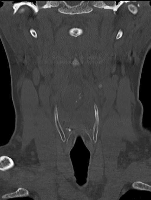 Chordoma (C4 vertebra) (Radiopaedia 47561-52188 Coronal bone window 9).png