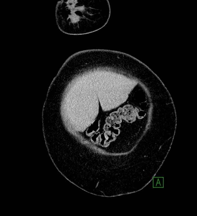Chromophobe renal cell carcinoma (Radiopaedia 84239-99519 F 8).jpg