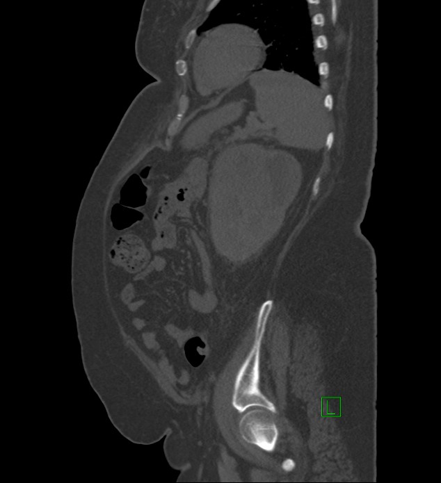 Chromophobe renal cell carcinoma (Radiopaedia 84239-99519 Sagittal bone window 24).jpg