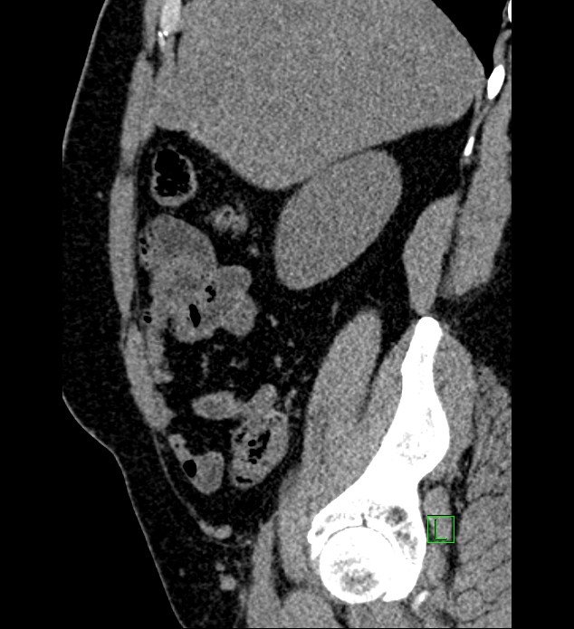 Chromophobe renal cell carcinoma (Radiopaedia 84286-99573 C 137).jpg