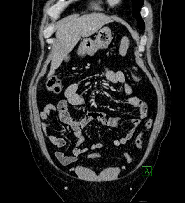 Chromophobe renal cell carcinoma (Radiopaedia 84286-99573 H 46).jpg