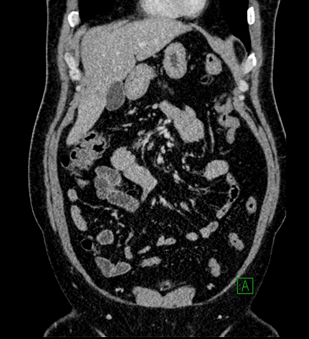 Chromophobe renal cell carcinoma (Radiopaedia 84286-99573 H 53).jpg