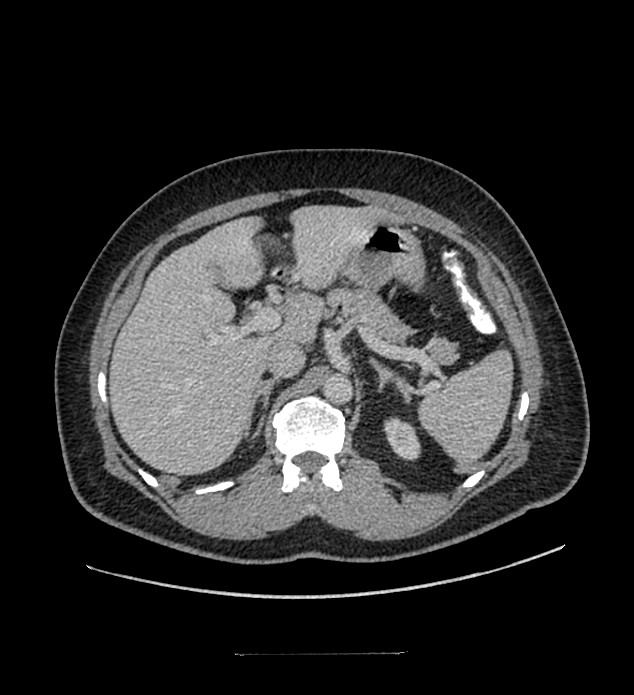 Chromophobe renal cell carcinoma (Radiopaedia 84337-99644 C 39).jpg