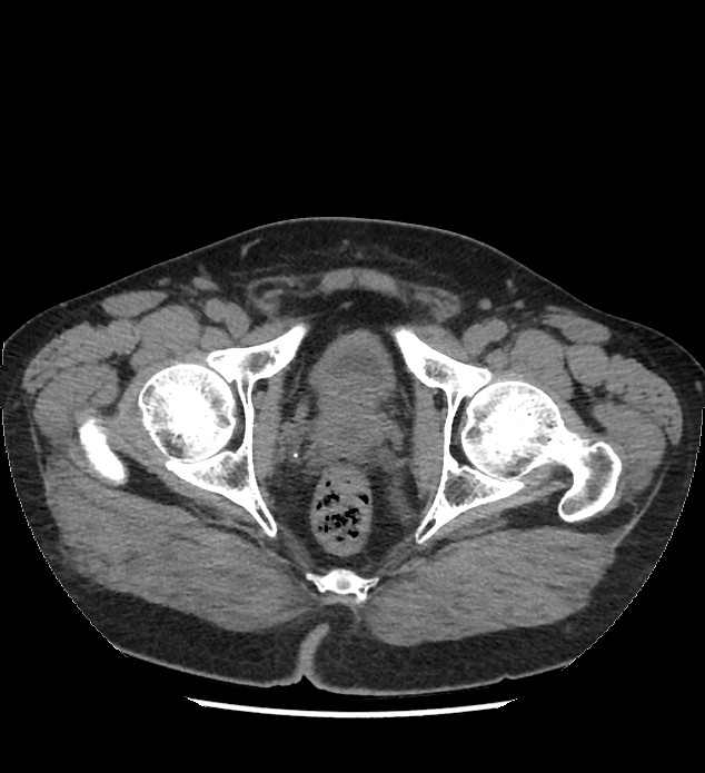Chromophobe renal cell carcinoma (Radiopaedia 86879-103083 Axial non-contrast 127).jpg