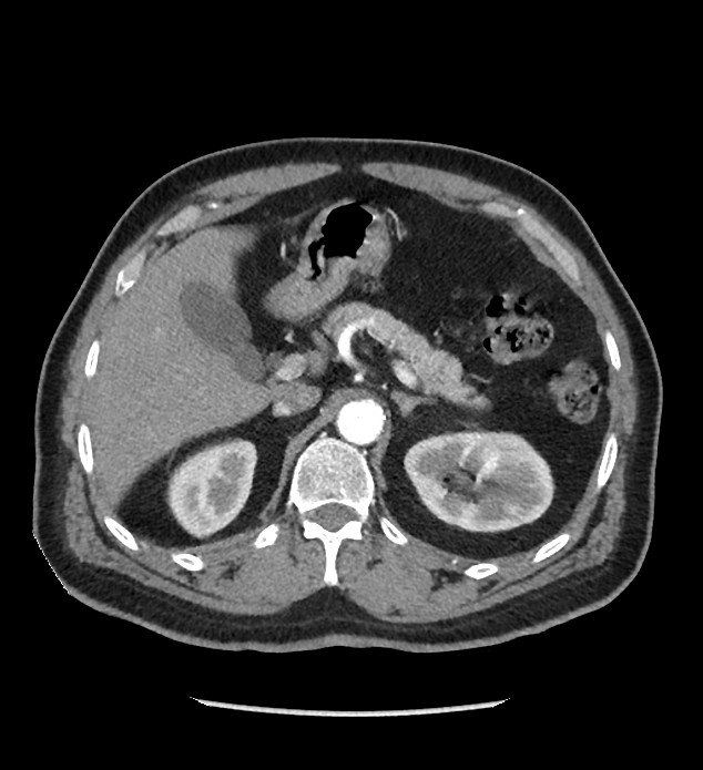 Chromophobe renal cell carcinoma (Radiopaedia 86879-103083 B 42).jpg