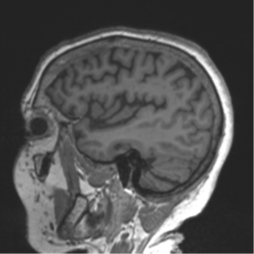 File:Chronic hypertensive encephalopathy (Radiopaedia 39993-42482 Sagittal T1 70).png