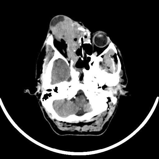 Chronic invasive fungal sinusitis with intraorbital and intracranial extension (Radiopaedia 56387-63046 B 89).jpg