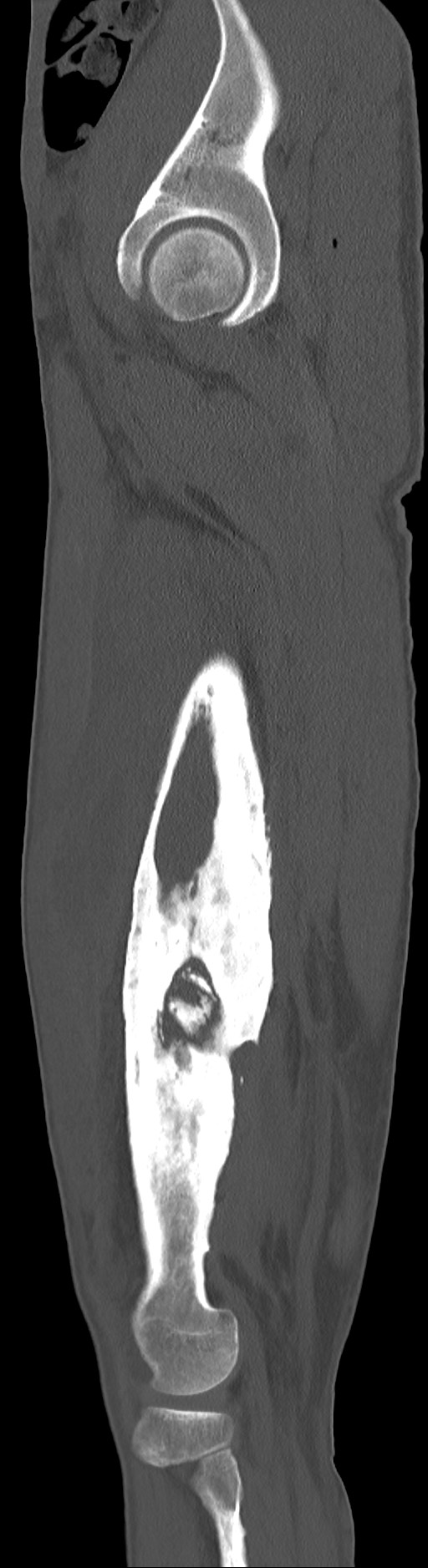 Chronic osteomyelitis (with sequestrum) (Radiopaedia 74813-85822 C 81).jpg