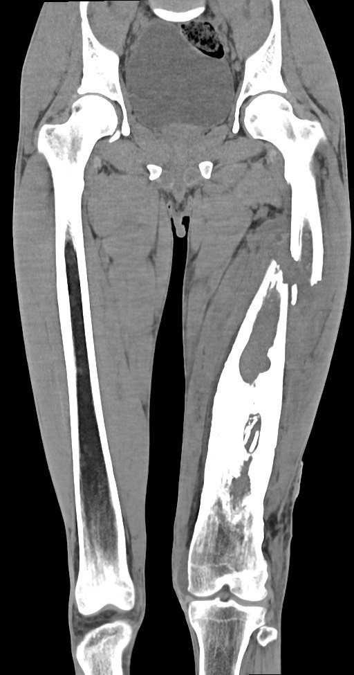 Chronic osteomyelitis (with sequestrum) (Radiopaedia 74813-85822 E 26).jpg