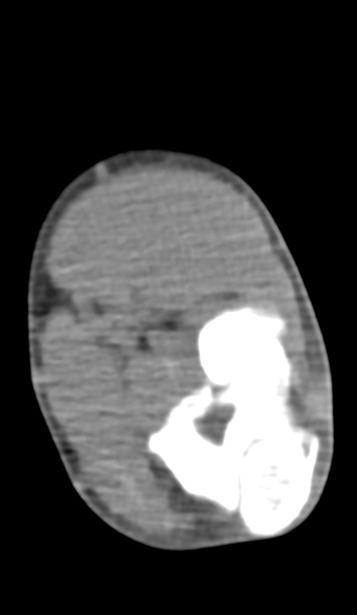 Chronic osteomyelitis of the distal humerus (Radiopaedia 78351-90971 Axial non-contrast 98).jpg
