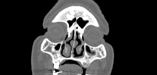 Chronic sphenoidal sinusitis (Radiopaedia 62030-70122 Coronal bone window 25).jpg
