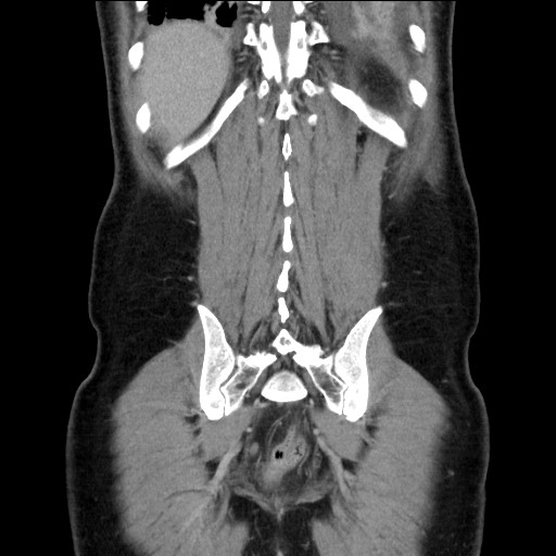 Chronic ureteropelvic junction obstruction (Radiopaedia 78365-90996 B 84).jpg