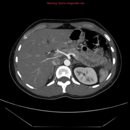 File:Circumaortic left renal vein (Radiopaedia 9069-9792 A 5).jpg
