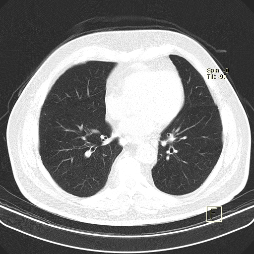 Classic complicated silicosis (Radiopaedia 49720-54961 Axial lung window 36).jpg