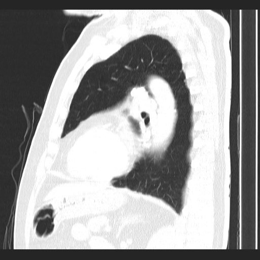 Classic complicated silicosis (Radiopaedia 49720-54961 Sagittal lung window 23).jpg