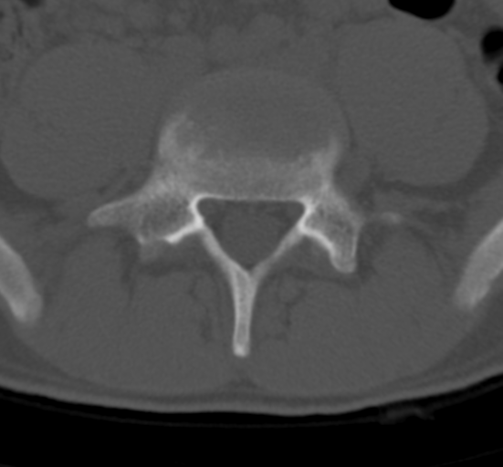 Clear cell meningoma - lumbar spine (Radiopaedia 60116-67691 Axial bone window 58).png