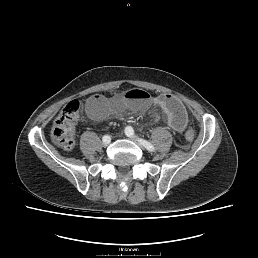 Closed loop bowel obstruction and ischemia (Radiopaedia 86959-103180 A 58).jpg