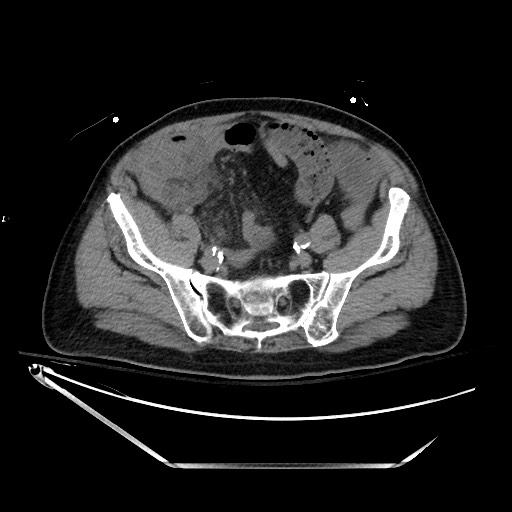 File:Closed loop obstruction due to adhesive band, resulting in small bowel ischemia and resection (Radiopaedia 83835-99023 Axial non-contrast 116).jpg