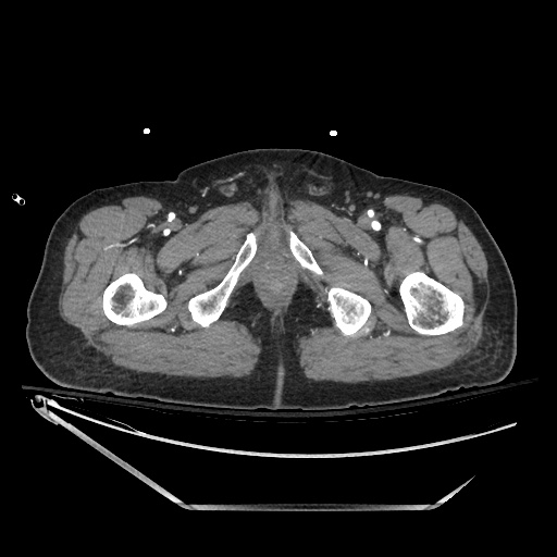 File:Closed loop obstruction due to adhesive band, resulting in small bowel ischemia and resection (Radiopaedia 83835-99023 B 165).jpg