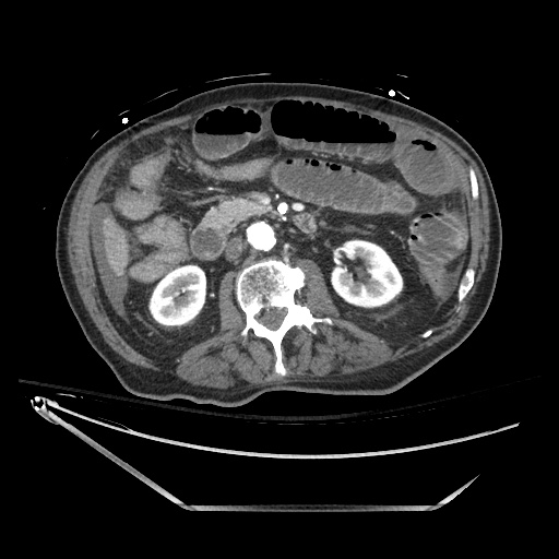 Closed loop obstruction due to adhesive band, resulting in small bowel ischemia and resection (Radiopaedia 83835-99023 B 66).jpg