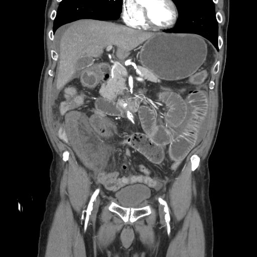 Closed loop obstruction due to adhesive band, resulting in small bowel ischemia and resection (Radiopaedia 83835-99023 C 52).jpg