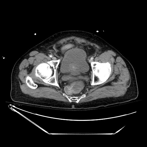File:Closed loop obstruction due to adhesive band, resulting in small bowel ischemia and resection (Radiopaedia 83835-99023 D 142).jpg