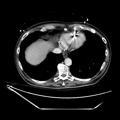 File:Closed loop obstruction due to adhesive band, resulting in small bowel ischemia and resection (Radiopaedia 83835-99023 D 20).jpg