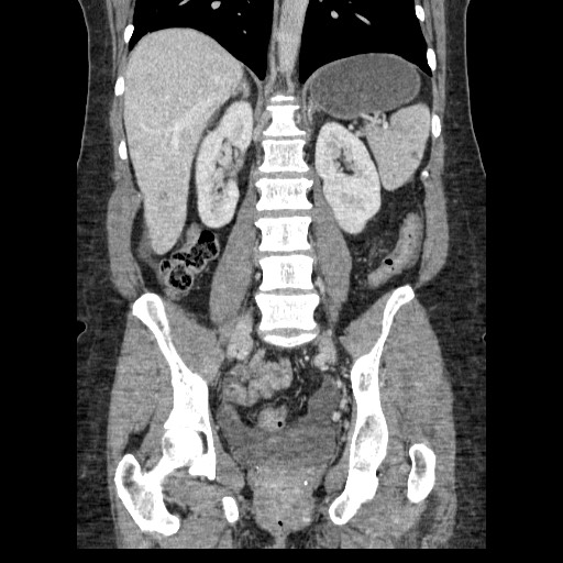 File:Closed loop small bowel obstruction (Radiopaedia 65403-74451 B 69).jpg