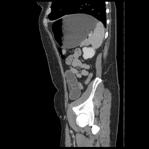 Closed loop small bowel obstruction (Radiopaedia 65403-74451 C 85).jpg