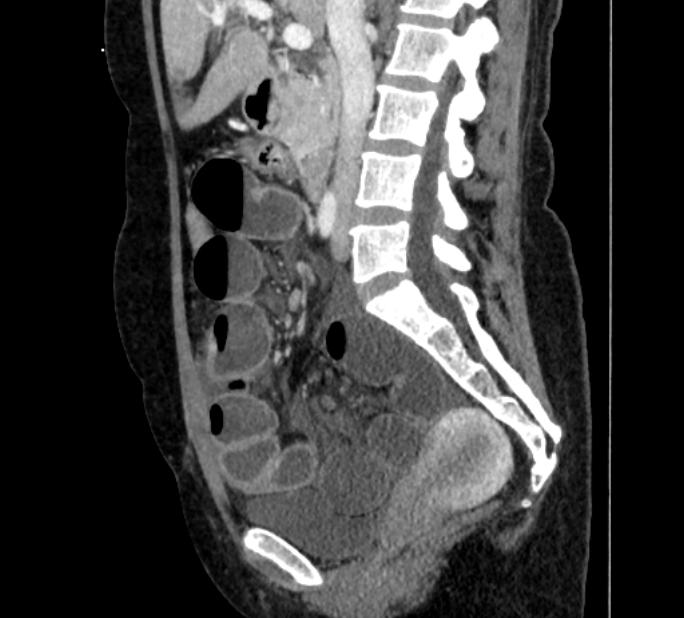 Closed loop small bowel obstruction (Radiopaedia 71211-81508 C 66).jpg