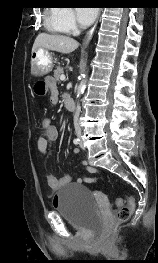 Closed loop small bowel obstruction - adhesions (Radiopaedia 59269-66611 C 56).jpg