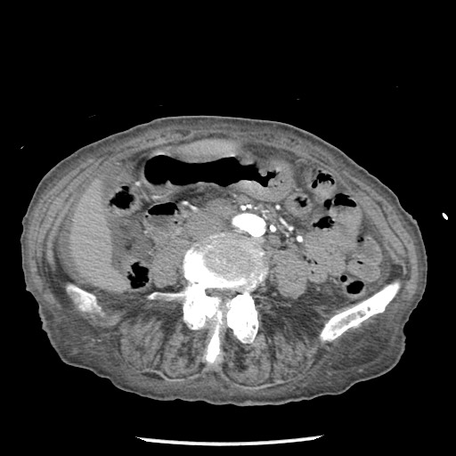 Closed loop small bowel obstruction - adhesions and infarct (Radiopaedia 85125-100678 A 99).jpg