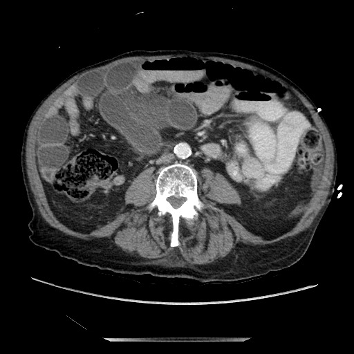 File:Closed loop small bowel obstruction - adhesive disease and hemorrhagic ischemia (Radiopaedia 86831-102990 A 107).jpg