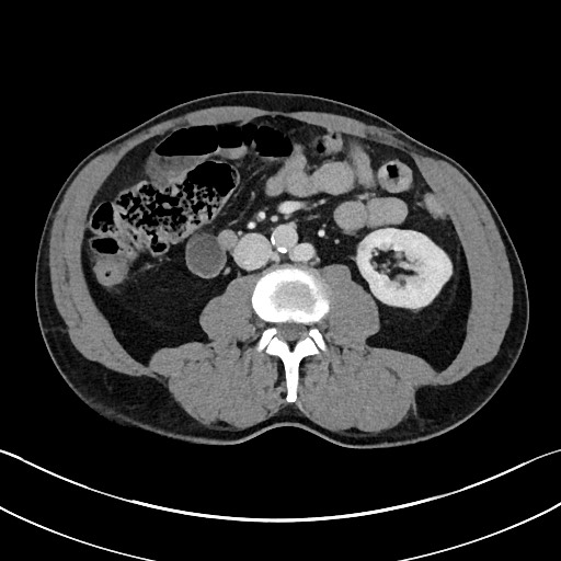 Closed loop small bowel obstruction - internal hernia (Radiopaedia 57806-64778 B 62).jpg