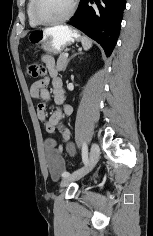 Closed loop small bowel obstruction - internal hernia (Radiopaedia 57806-64778 C 42).jpg