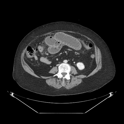File:Closed loop small bowel obstruction - internal hernia (Radiopaedia 65402-74450 A 72).jpg