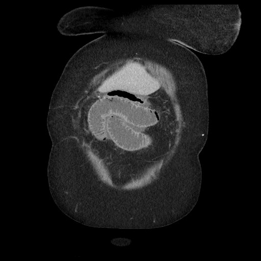 Closed loop small bowel obstruction - internal hernia (Radiopaedia 65402-74450 B 15).jpg