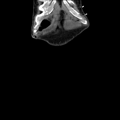 File:Closed loop small bowel obstruction - omental adhesion causing "internal hernia" (Radiopaedia 85129-100682 B 15).jpg
