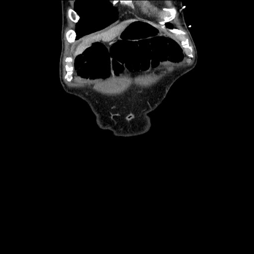 Closed loop small bowel obstruction - omental adhesion causing "internal hernia" (Radiopaedia 85129-100682 B 22).jpg