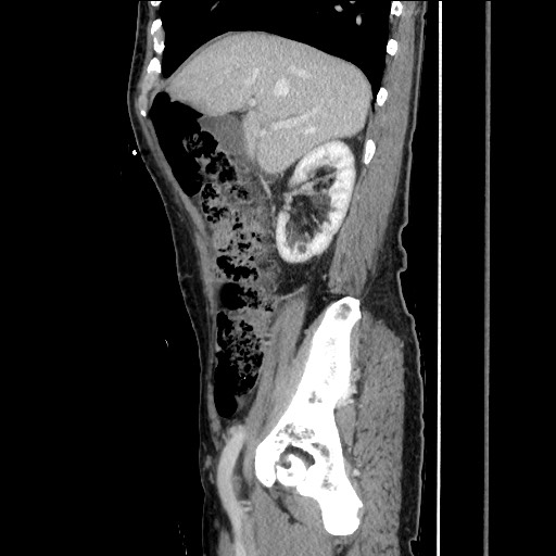 File:Closed loop small bowel obstruction - omental adhesion causing "internal hernia" (Radiopaedia 85129-100682 C 61).jpg